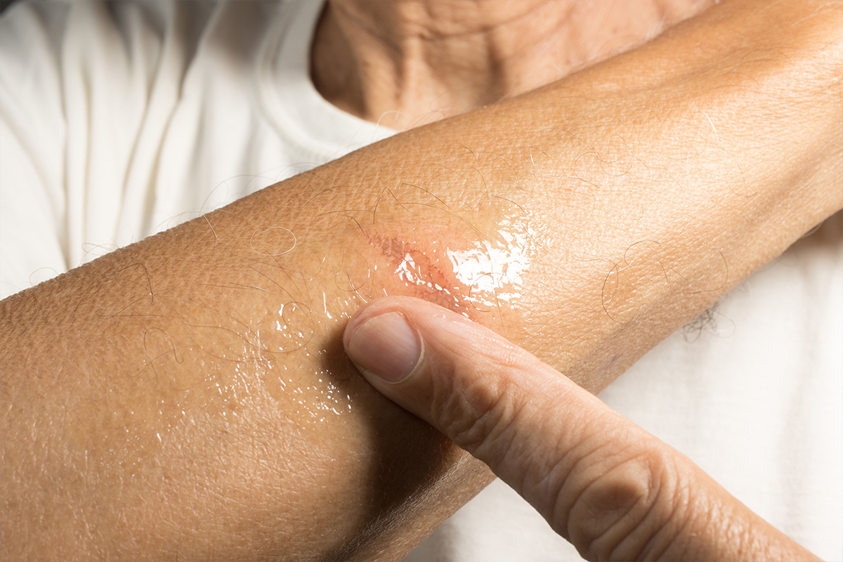 Treatments for Minor to Moderate Burns