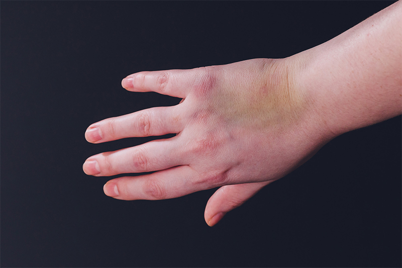 Symptoms of Soft Tissue Injuries