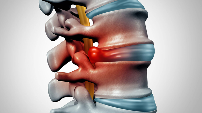 Hyperextension and Compression of the Spine