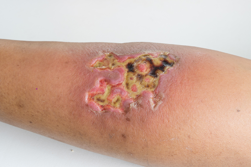 Causes of Burns in Plantation