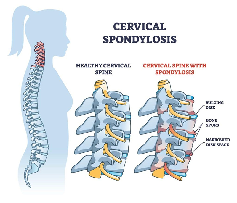 Types of Neck Injuries in Albuquerque