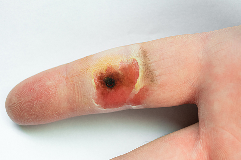 Common Causes of Burn Injuries