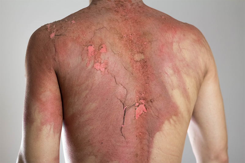 What are The Common Causes of Burn Injuries?