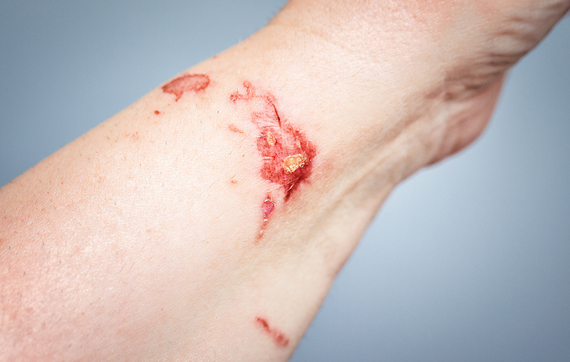 "What Are the Different Sources of Burn Injuries?"