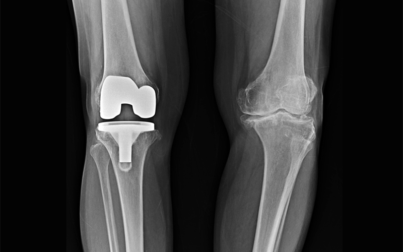 What is Knee Injury?