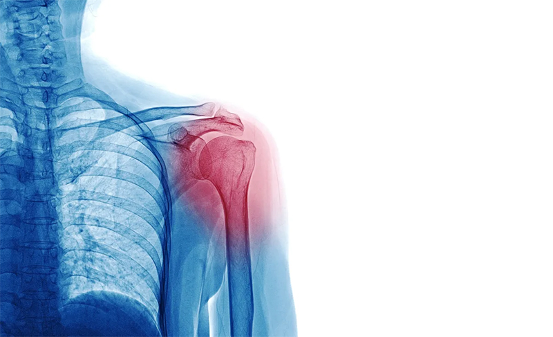 What are Shoulder Injuries?