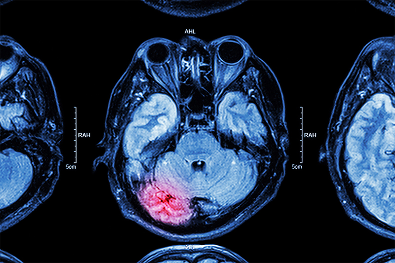 Understanding Traumatic Brain Injury (TBI)