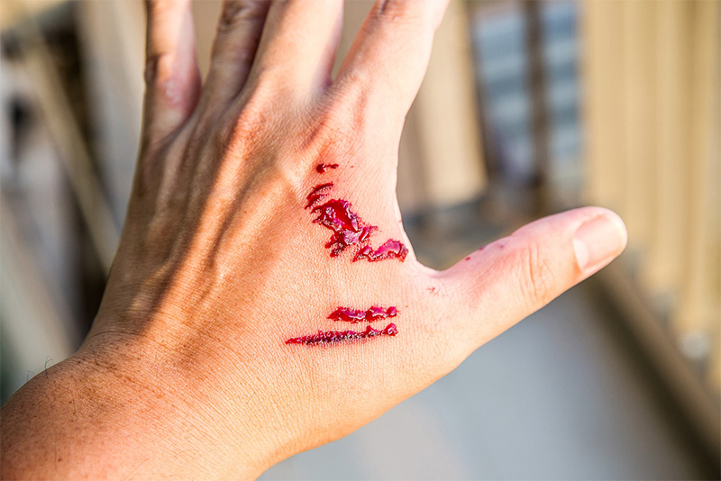 Dog Bite Injuries