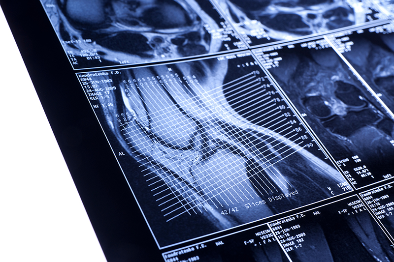 Common Injuries in PI Cases