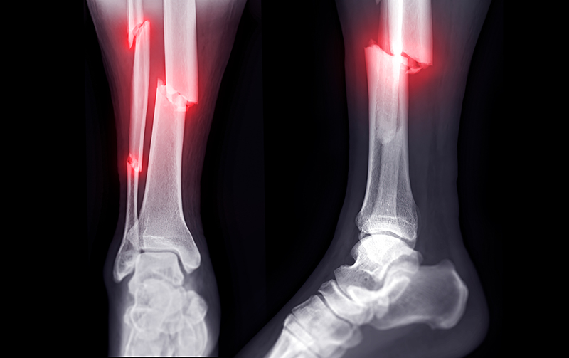 Injuries Sustained By Victims of Side-Impact Accident