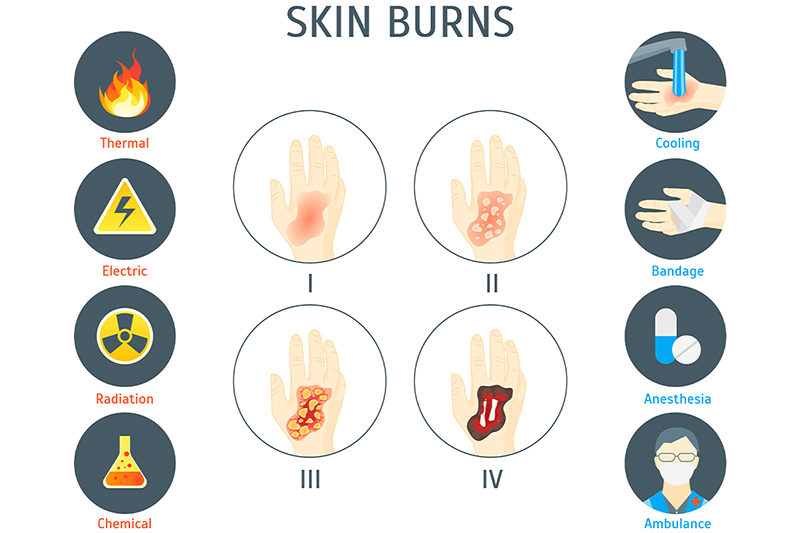 Levels of Burn Injury