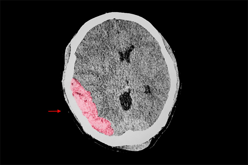 Lesión Cerebral Grave