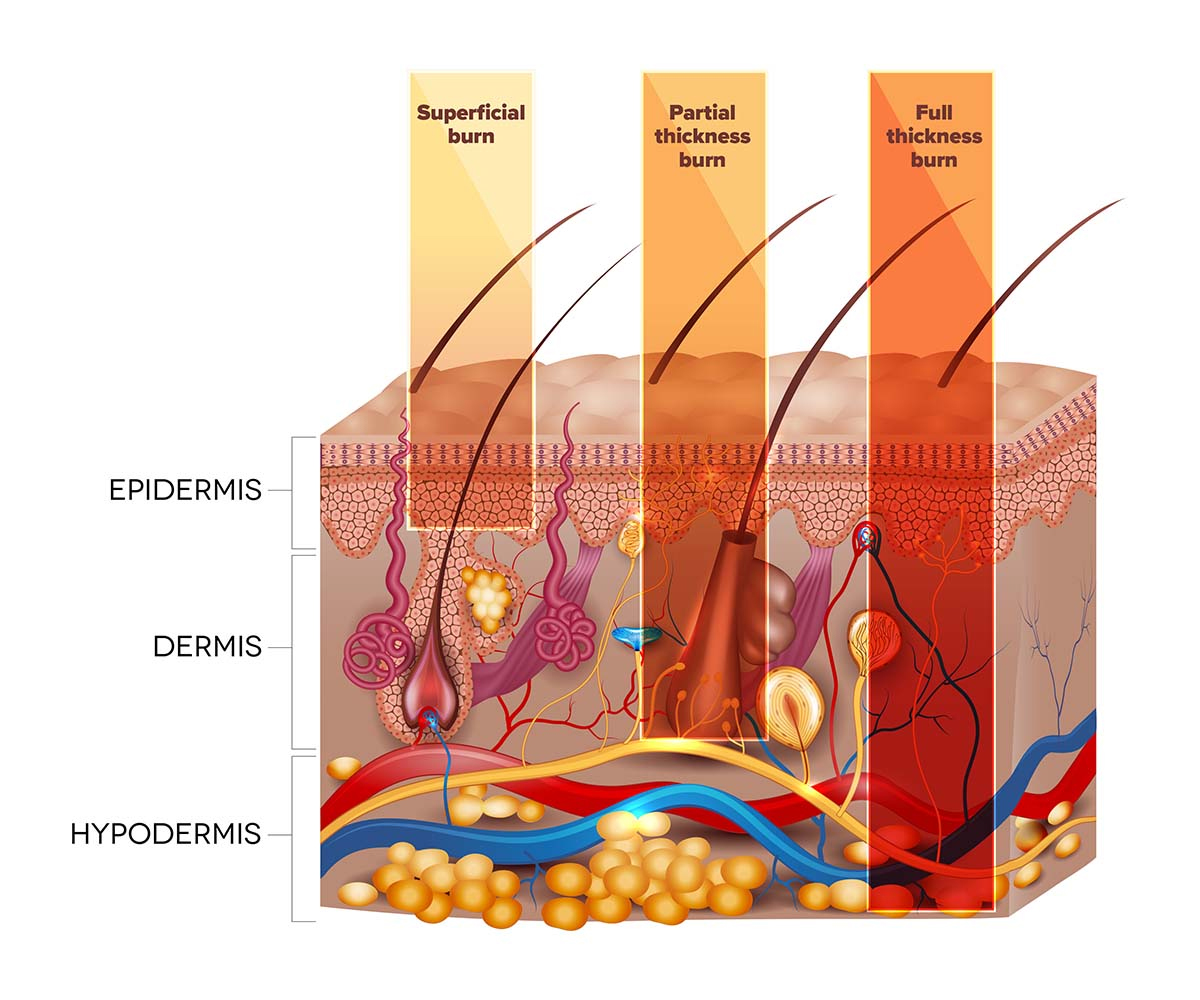 Burn Injury Degrees