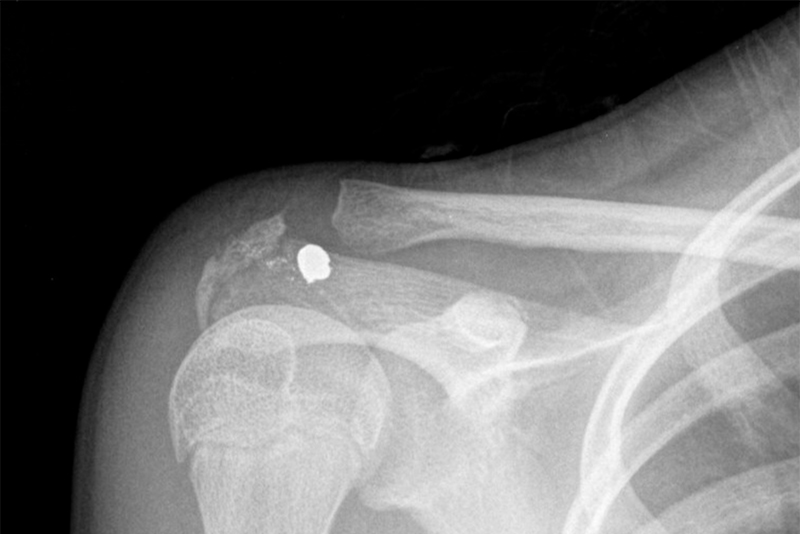 Salem Hunting Accident Injuries