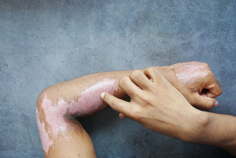 What Are The Common Causes of Burns in Gresham?