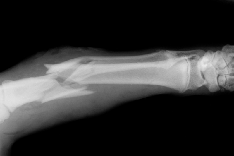 What Common Injuries Are Caused by LA Construction Accidents?