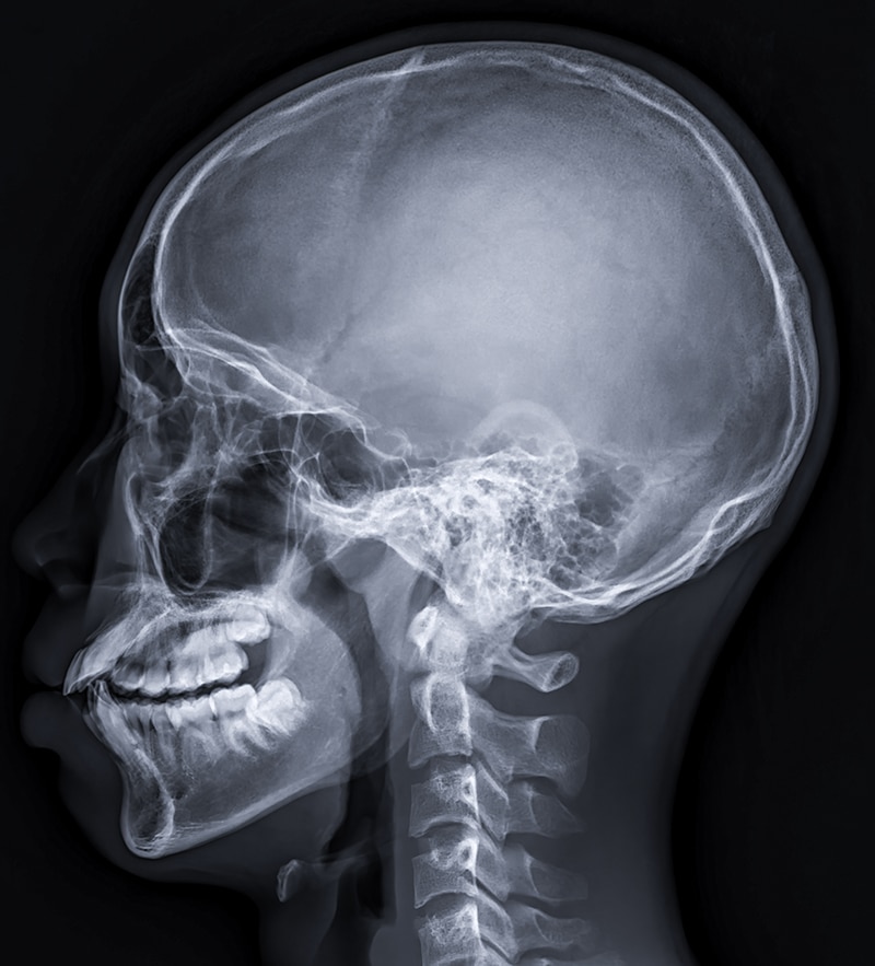 Types of Brain Injuries: Skull fractures